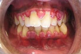 Gums Inflammation